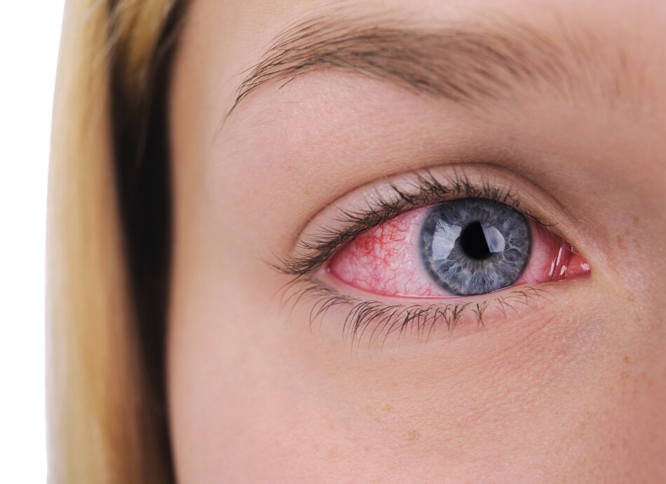 Closeup of woman's right eye with uveitis or inflammation