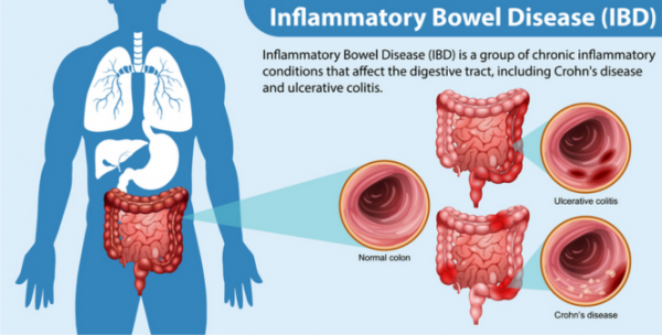 Depiction of the colon with examples of a normal colon and one with Crohn's disease and one with ulcerative colitis