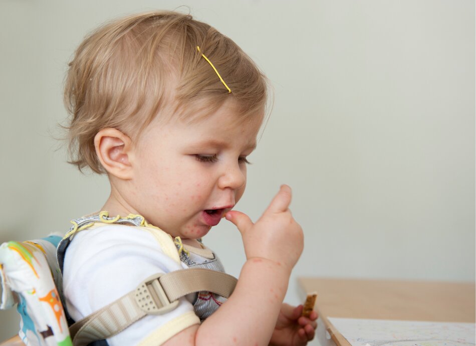 Toddler with rash from hand foot and mouth disease