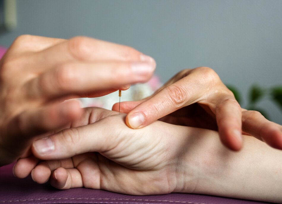 Acupuncture needle going into right hand