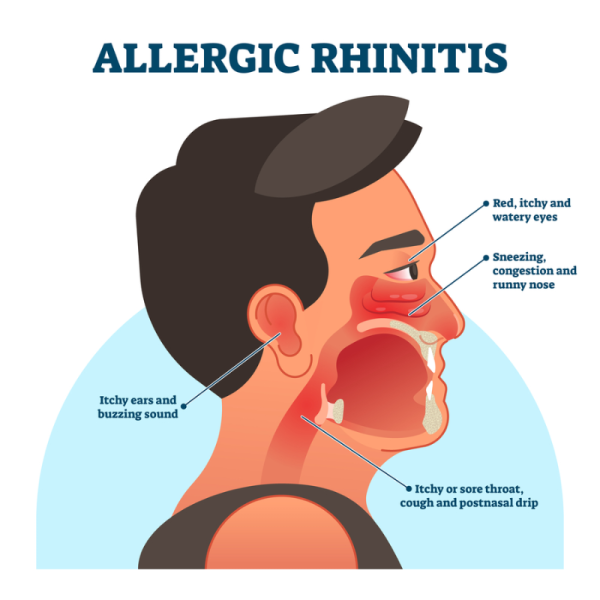 Symptoms of hay fever