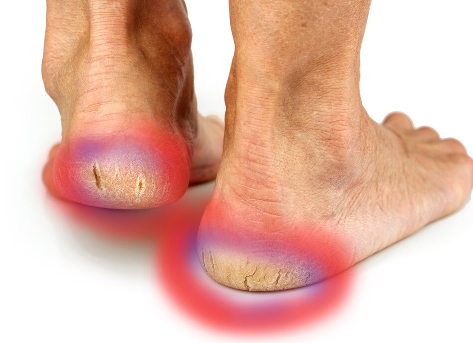 Illustration of cracked heels on feet