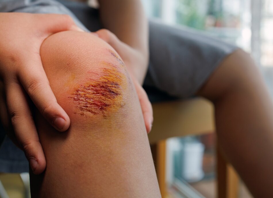 Closeup of boy's grazed knee