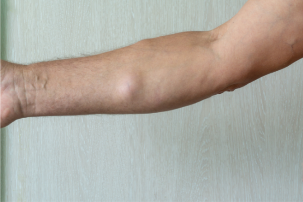 Lipoma on man's forearm