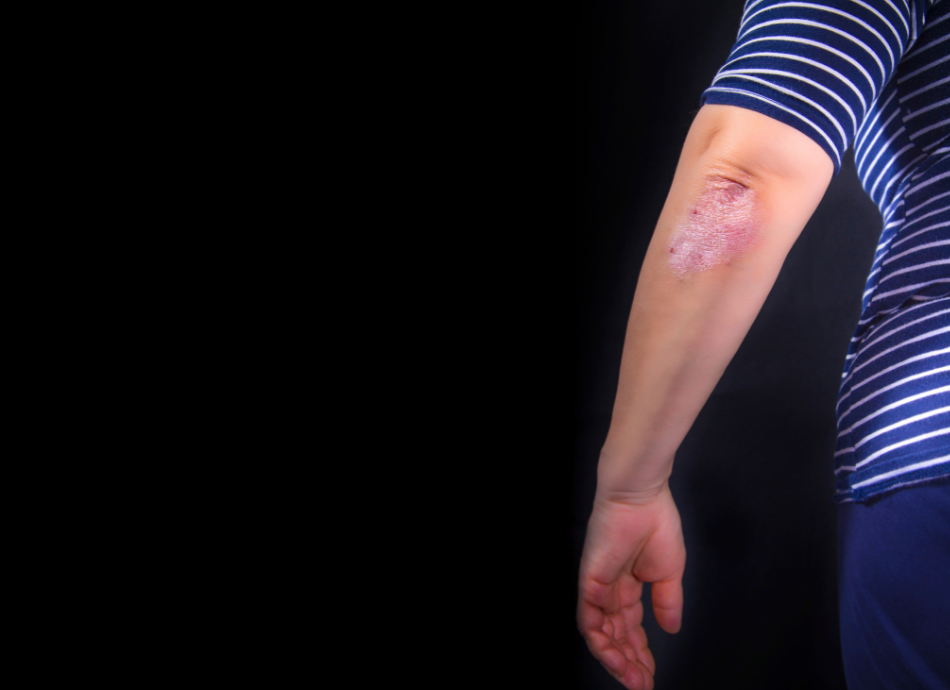 Psoriasis on elbow