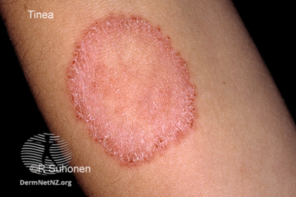 Photo of ringworm