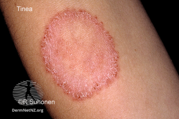 Photo of ringworm 