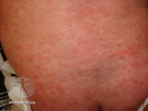 Roseola rash on baby's back