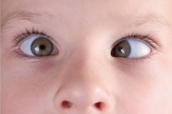 Young child with squint in eyes