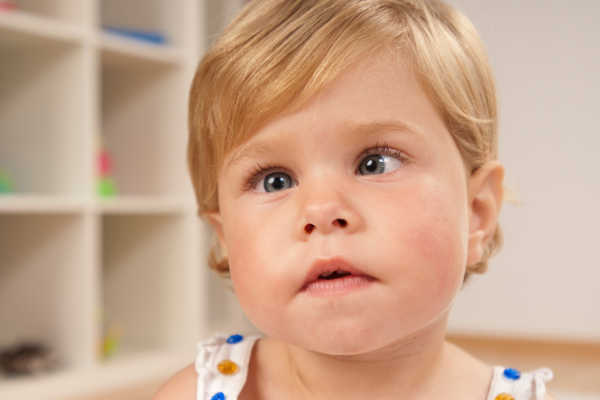 Young girl with amblyopia in eyes