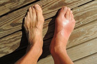 Swelling and gout in foot