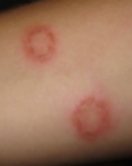 Ringworm on skin